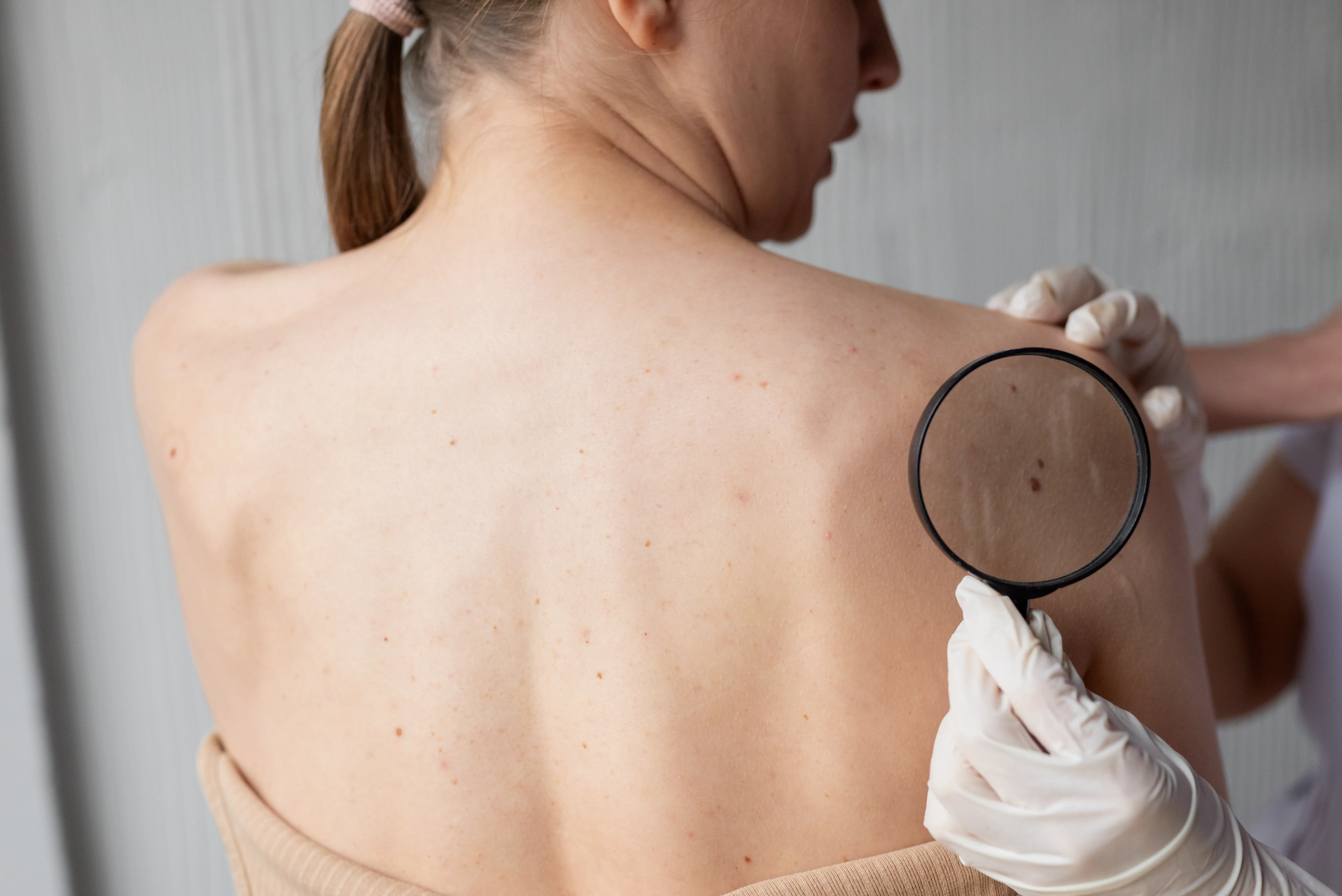 Conheça os sintomas de câncer de pele