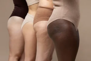 Diversas mulheres apresentam sinais de lipedema nos quadris