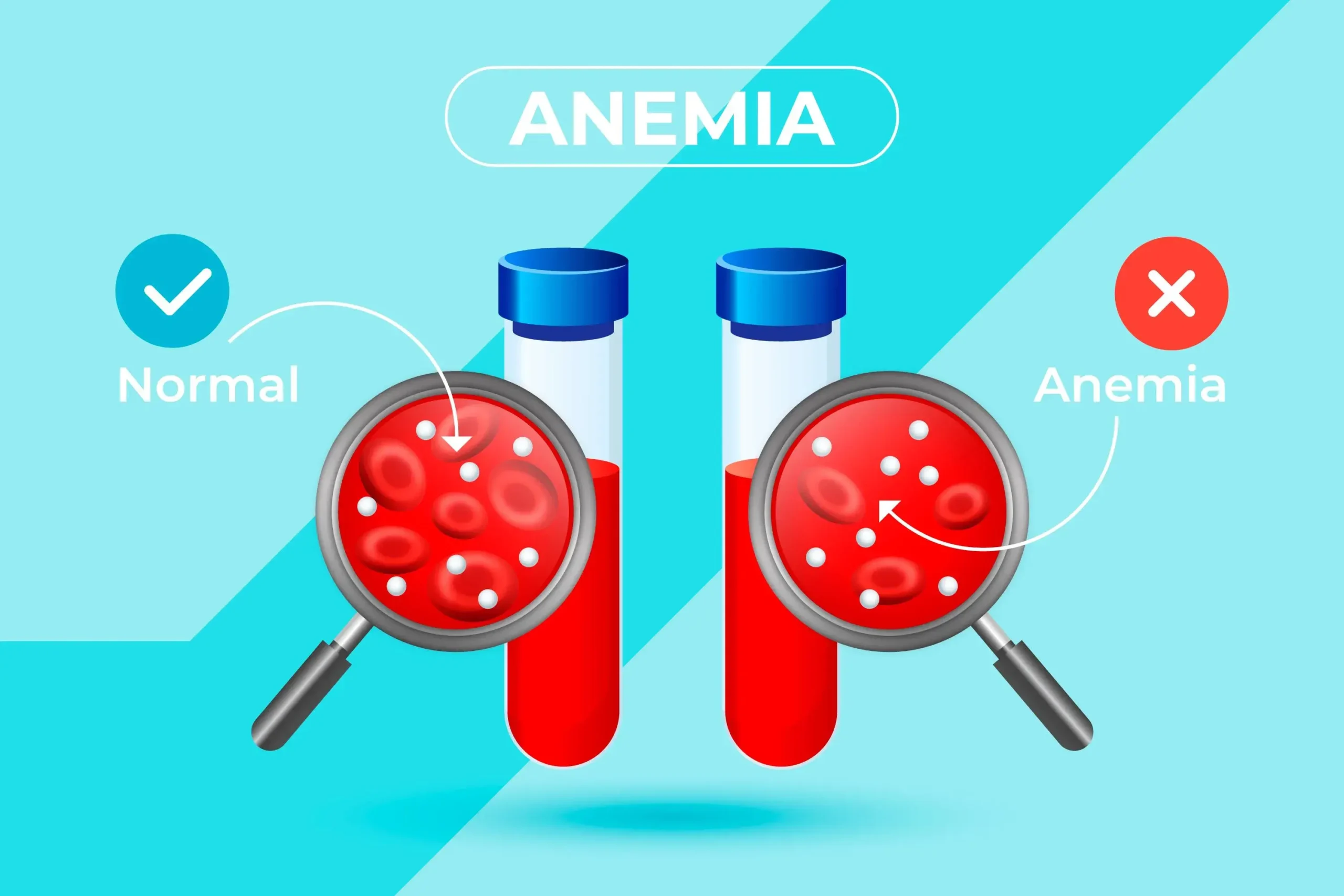 Entenda o que é anemia, sintomas e tipos como anemia hemolítica￼