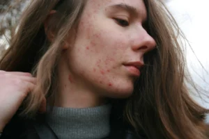Imagem representa acne da mulher adulta.