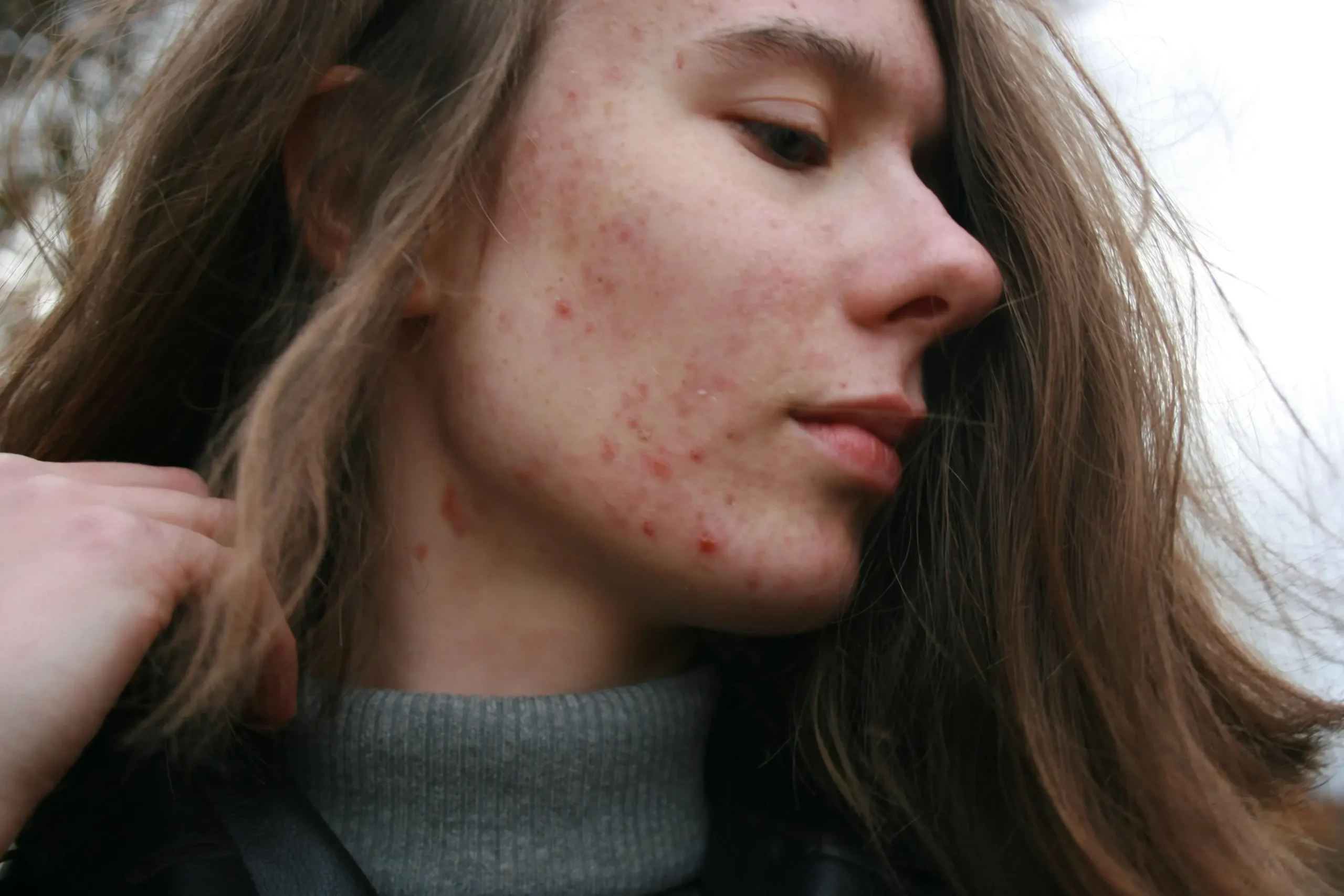 Espinha depois dos 25? Entenda a acne da mulher adulta