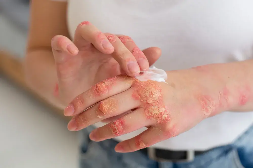 Doença celíaca com sintomas na pele e lesões associadas à dermatite herpetiforme.