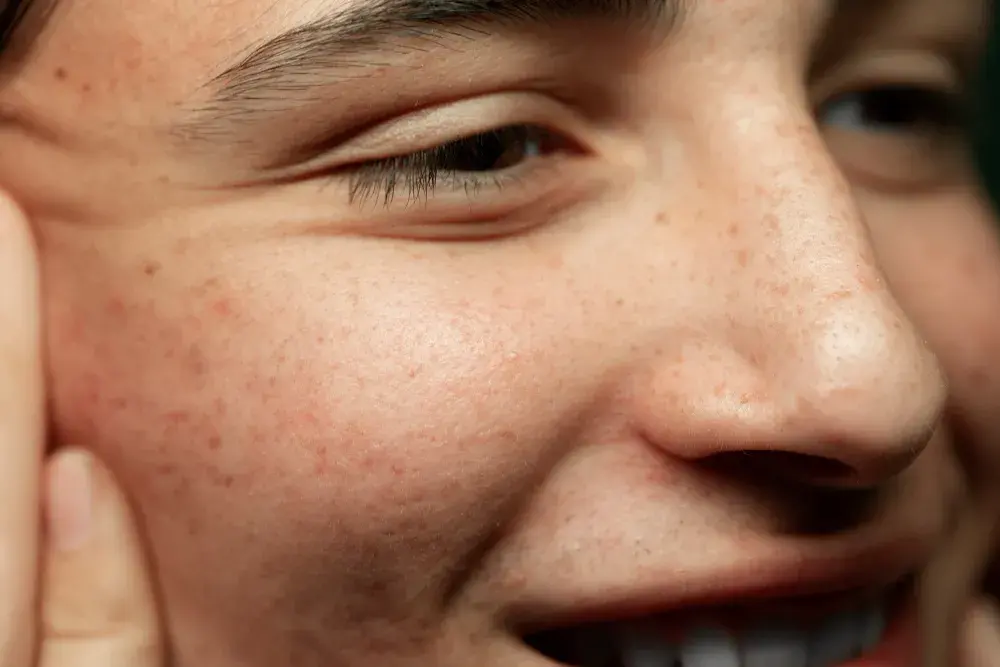 7 erros que pioram as manchas de melasma